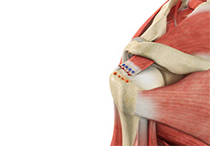 3 Common Rotator Cuff Injuries  Seacoast Orthopedics & Sports Medicine,  Newburyport, MA